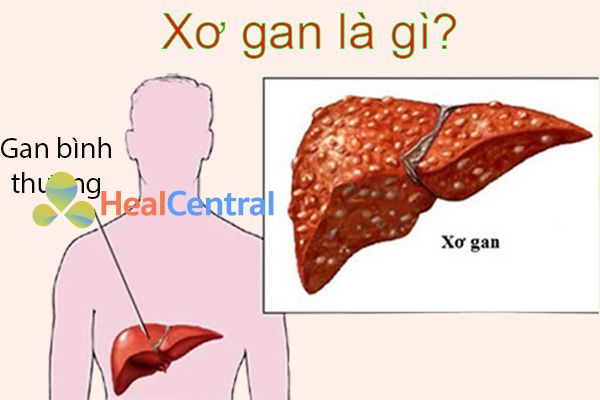Xơ gan là gì? Nguyên nhân; triệu chứng; cách điều trị
