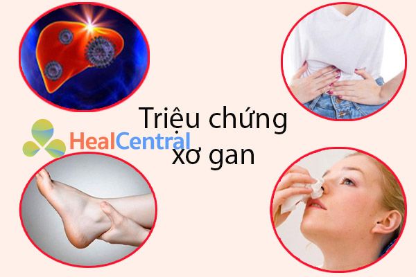 Những triệu chứng cho thấy bạn bị sơ gan.