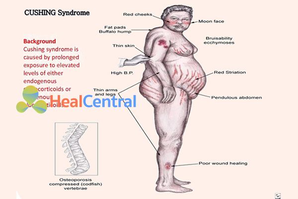 Bệnh nhân mắc hội chứng Cushing