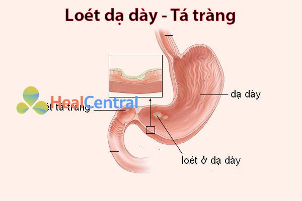 Công dụng của nghệ trong chữa đau dạ dày