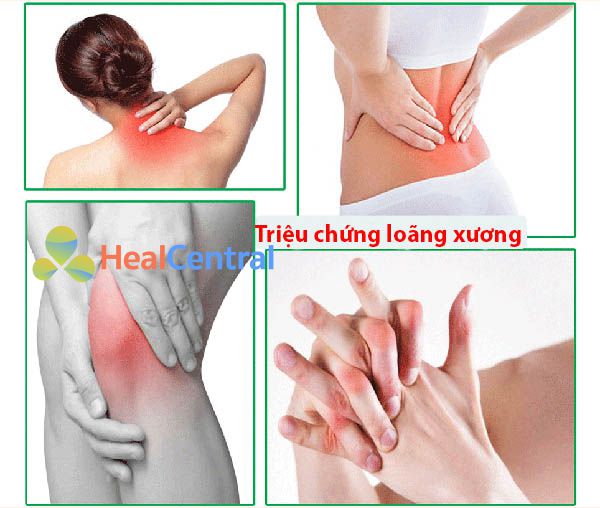 Triệu chứng của loãng xương