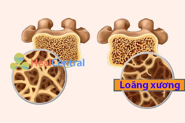 Thiếu canxi gây ra tình trạng loãng xương