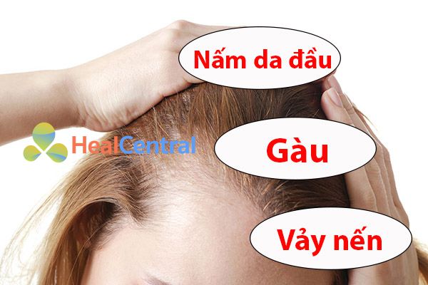 Phân biệt nấm da đầu với các bệnh da liễu khác