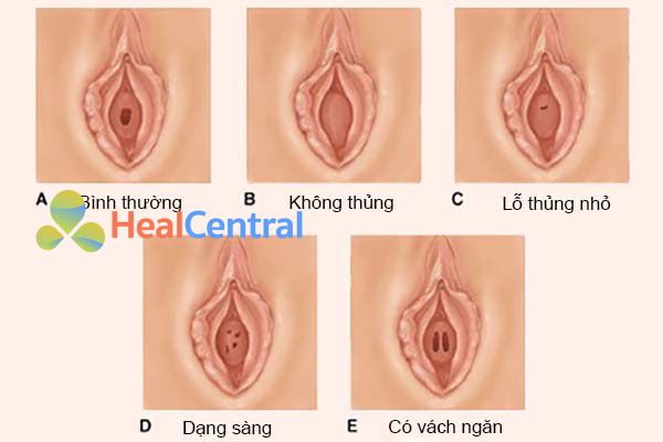 Các loại màng trinh