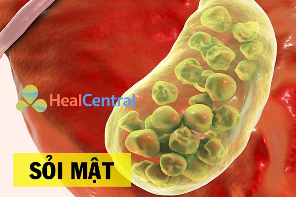Nguyên nhân gây sỏi mật
