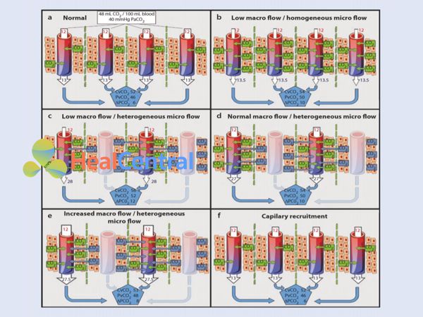 Các biến thể lưu lượng máu vĩ mô và vi tuần hoàn và ảnh hưởng của nó đến Pv-aCO2
