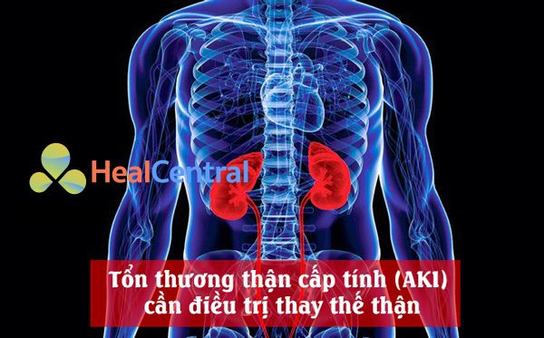 Tổn thương thận cấp tính (AKI) cần điều trị thay thế thận (RRT)