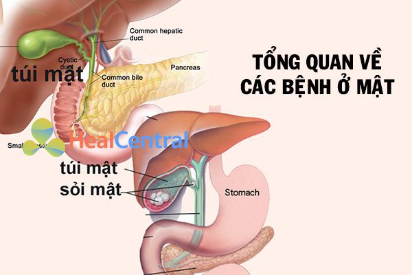 Sỏi mật là gì?
