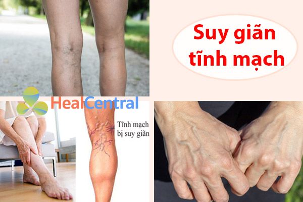 Suy giãn tĩnh mạch là bệnh gì? Nguyên nhân, Triệu chứng và Phòng ngừa