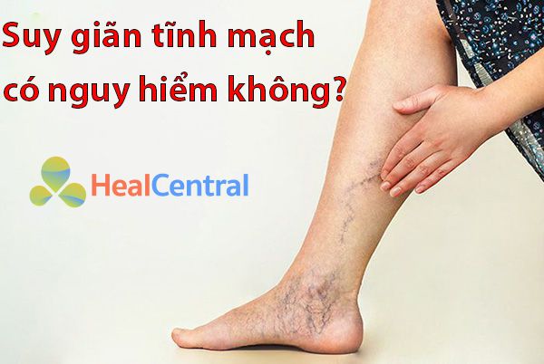 Bệnh suy giãn tĩnh mạch có nguy hiểm không?