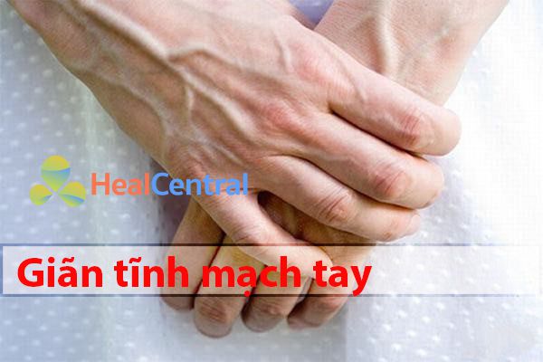 Giãn tĩnh mạch tay khá lành tính với người bệnh