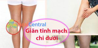 Suy giãn tĩnh mạch chân là bệnh gì?