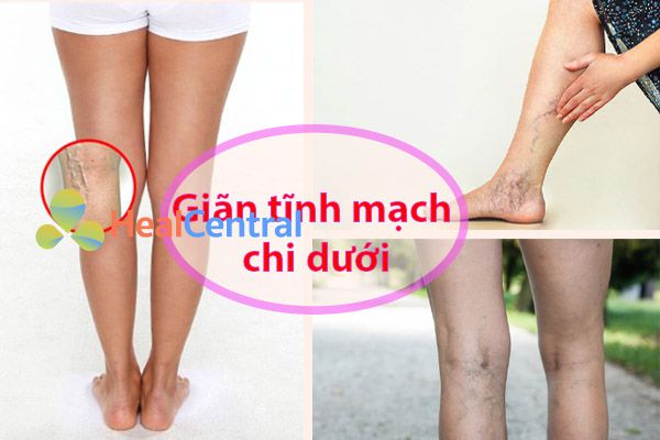 Giãn tĩnh mạch chi dưới nguy hiểm không? nguyên nhân và phòng ngừa