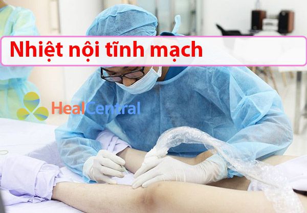 Điều trị suy giãn bằng nhiệt nội tĩnh mạch