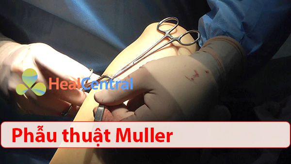 Phẫu thuật Muller điều trị suy giãn tĩnh mạch chi dưới