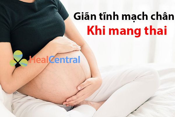 Giãn tĩnh mạch chân khi mang thai có nguy hiểm không?