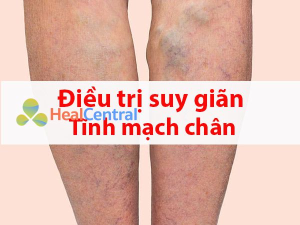 Điều trị giãn tĩnh mạch chân