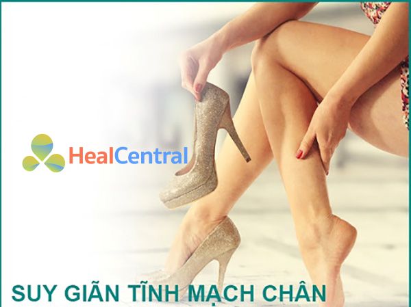 Giãn tĩnh mạch: Là tình trạng tĩnh mạch có những biến đổi bất thường về giải phẫu