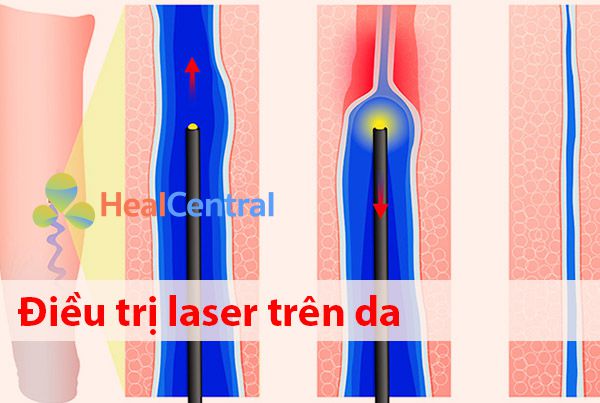 Điều trị laser trên da