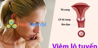 Bệnh viêm lộ tuyến cổ tử cung