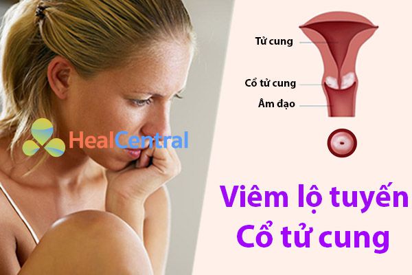 Viêm lộ tuyến tử cung là gì? chữa ở đâu? và chi phí chữa