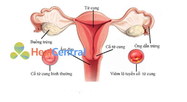 Hình ảnh: Viêm lộ tuyến cổ tử cung