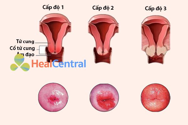 Các cấp độ của bệnh viêm lộ tuyến cổ tử cung