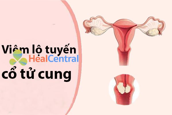 Viêm lộ tuyến cổ tử cung có nguy hiểm không?