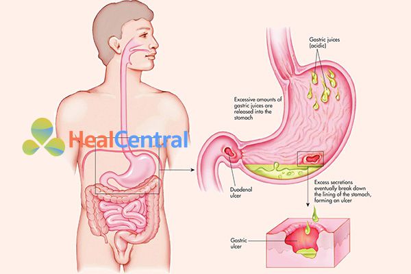 Viêm loét dạ dày - tá tràng là gì?