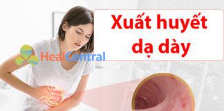 Xuất huyết dạ dày