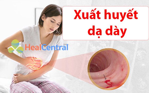 Xuất huyết dạ dày là gì? nguyên nhân, triệu chứng và cách điều trị