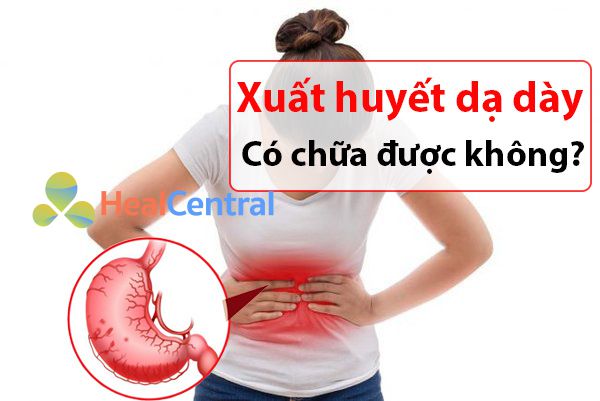 Xuất huyết dạ dày có chữa được không?