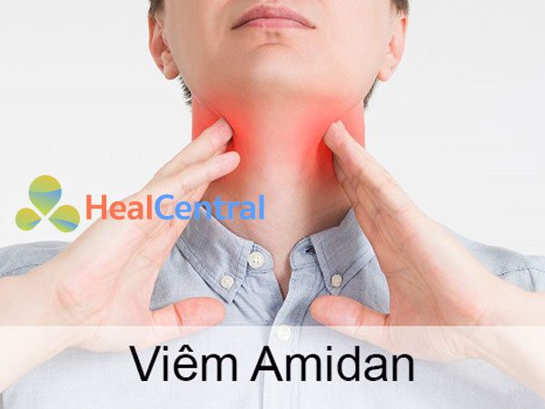Viêm Amidan | Dấu hiệu, Hình ảnh, Biểu hiện, Cách chữa trị hiệu quả