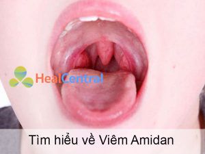 Tìm hiểu Viêm Amidan là gì?