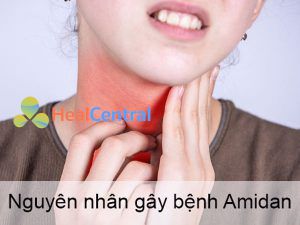 Nguyên nhân gây bệnh Viêm Amidan