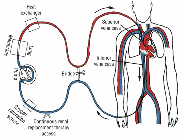 Oxy hóa máu qua màng ngoài cơ thể (ECMO)