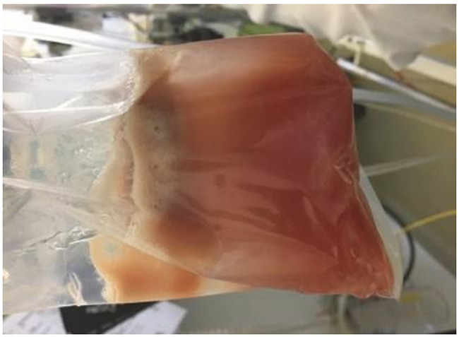 Dịch tiết khí quản được hút ra của bệnh nhân bị giãn phế quản, là kết quả của việc hút máu từ phần trên Hình