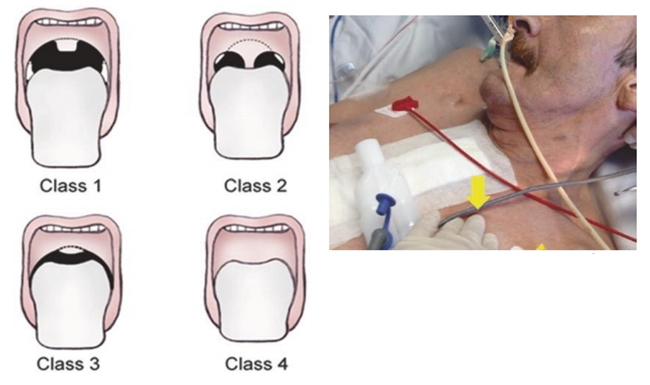 Kỹ thuật sàng lọc nhanh để đánh giá vị trí đặt ống nội khí quản ở hơi thở đầu tiên với túi thông khí