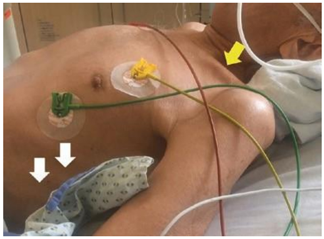 Sự co rút liên sườn (mũi tên trắng) và co rút hõm thượng đòn (mũi tên màu vàng) ở một bệnh nhân mắc COPD và suy hô hấp