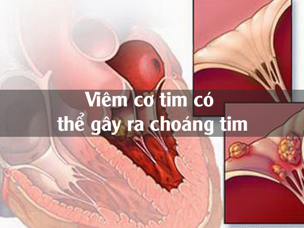 Viêm cơ tim gây choáng tim