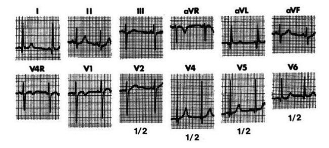 ECG của một trẻ 4 tuổi được chẩn đoán thông liên thất lỗ vừa