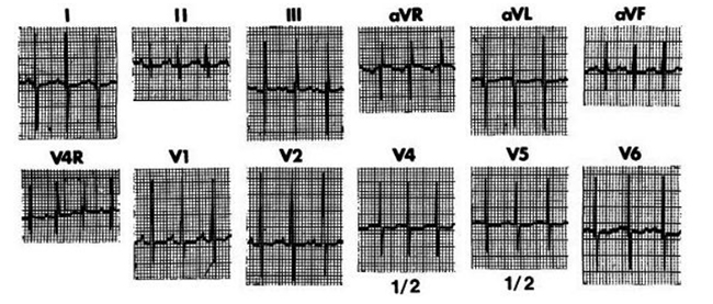 ECG của một nhũ nhi 2 tháng tuổi được chẩn đoán thông liên thất lỗ lớn