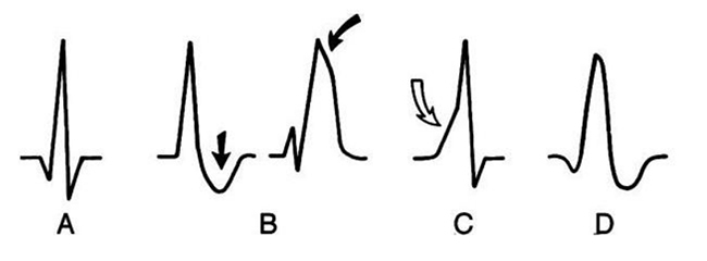 Minh hoạ ba kiểu rối loạn dẫn truyền trong thất