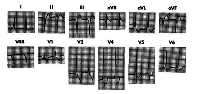 ECG ở một trẻ trai 2 tuổi không triệu chứng và có thông liên thất tự đóng