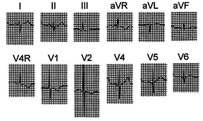 ECG ở một trẻ sơ sinh 1 tuần tuổi