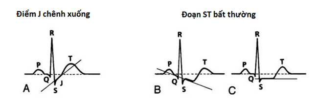 Những biến đổi không bệnh lý (không thiếu máu) và bệnh lý (thiếu máu cục bộ) của đoạn ST và sóng T. A