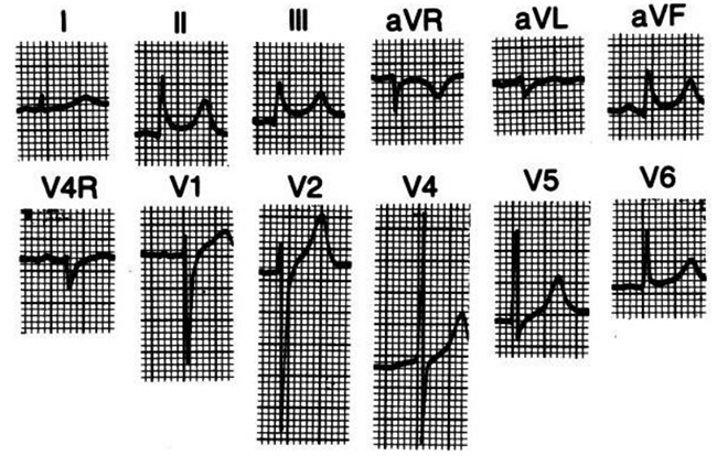 Bản ghi ECG của một trẻ nam 16 tuổi có biểu hiện tái cực sớm và điểm J chênh xuống