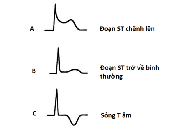 Biến đổi theo thời gian của đoạn ST và sóng T trong viêm màng ngoài tim
