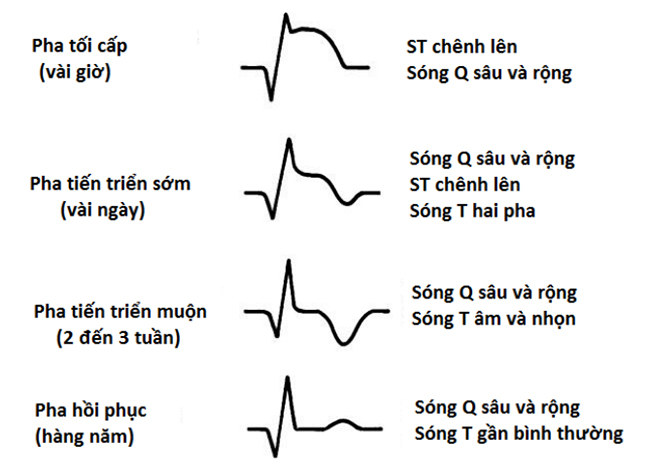 Biến đổi theo thời gian của ST và sóng T trong nhồi máu cơ tim