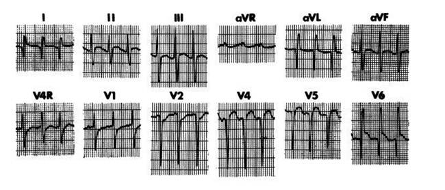 ECG của một nhĩ nhi 2 tháng tuổi có xuất phát bất thường của động mạch vành trái từ động mạch phổi